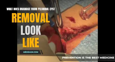 Understanding the Appearance of Drainage after Pilonidal Cyst Removal