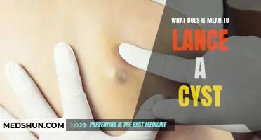 Understanding the Process: What Does it Mean to Lance a Cyst?