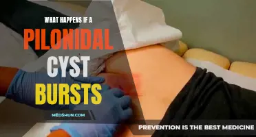 What Happens When a Pilonidal Cyst Bursts: Symptoms and Treatment