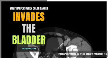 When Colon Cancer Invades the Bladder: Here's What You Need to Know