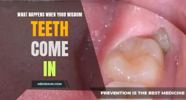 The Complete Guide to Understanding What Happens When Your Wisdom Teeth Come In