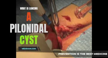 Lancing a Pilonidal Cyst: Understanding the Procedure and Benefits