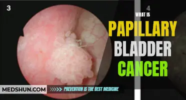 Understanding the Basics of Papillary Bladder Cancer