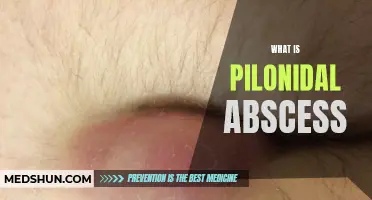 Understanding Pilonidal Abscess: Causes, Symptoms, and Treatment Options