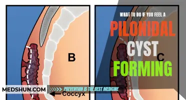 What to Do If You Feel a Pilonidal Cyst Forming and How to Treat It