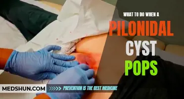 What to Do When a Pilonidal Cyst Pops: Treatment and Prevention Tips