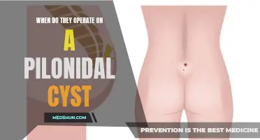 Understanding When and How Surgeons Operate on a Pilonidal Cyst