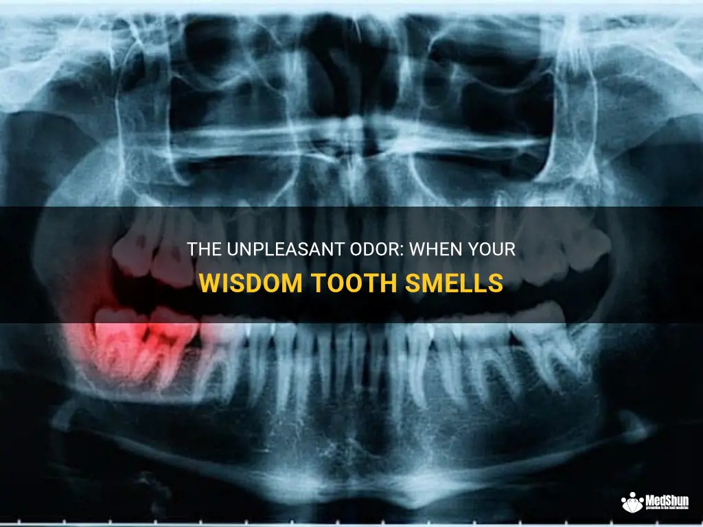 The Unpleasant Odor: When Your Wisdom Tooth Smells | MedShun