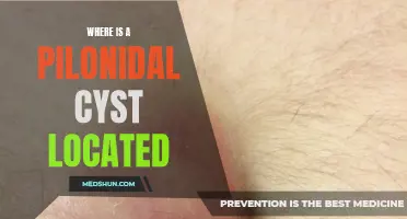 Understanding the Location of a Pilonidal Cyst: What You Need to Know