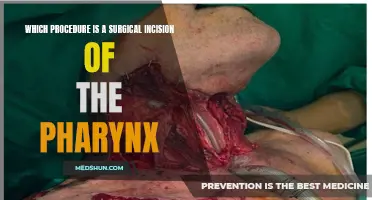 Surgical Incision of the Pharynx: Which Procedure is Right for You?