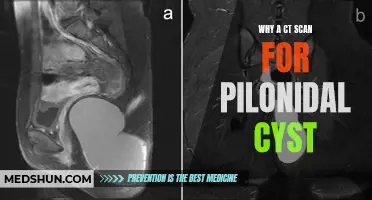The Importance of a CT Scan in Diagnosing a Pilonidal Cyst