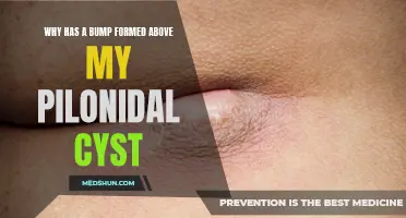 Understanding the Formation of a Bump Above Your Pilonidal Cyst