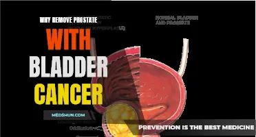 The Importance of Removing the Prostate With Bladder Cancer