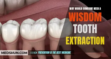 The Importance of Wisdom Tooth Extraction and Its Benefits