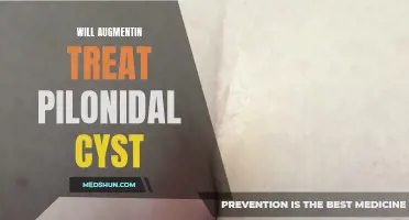 Can Augmentin Successfully Treat a Pilonidal Cyst?