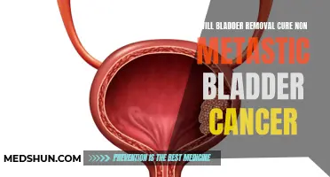 Bladder Removal: Can it Cure Non-Metastatic Bladder Cancer?