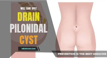 Can Care Spot Help Drain a Pilonidal Cyst?