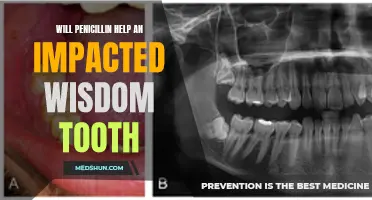 How Does Penicillin Impact an Impacted Wisdom Tooth?