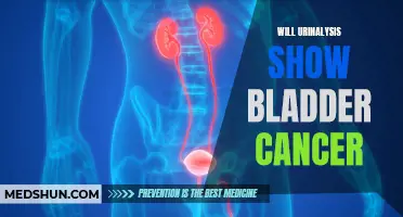 Understanding How Urinalysis Can Detect Bladder Cancer