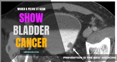 Exploring the Effectiveness of Pelvic CT Scans in Detecting Bladder Cancer