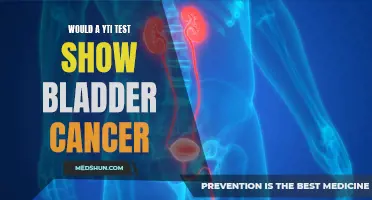 Detecting Bladder Cancer: Can a YTI Test Provide Accurate Results?